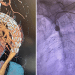 Tevar- in situ fenestracija